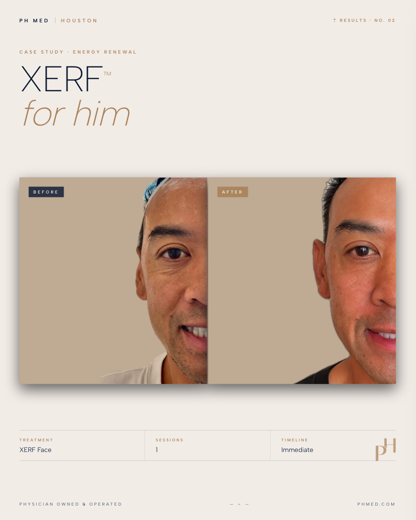 XERF Before and After - for him