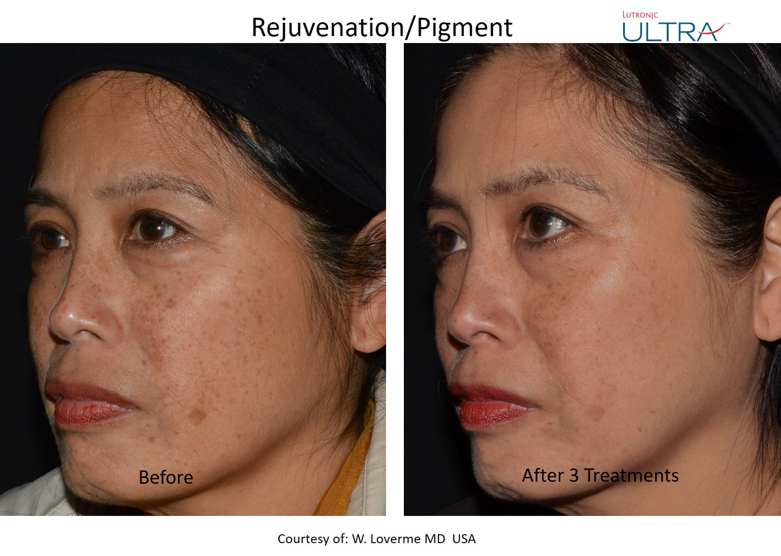 LaseMD Ultra before and after - Pigmentation treatment