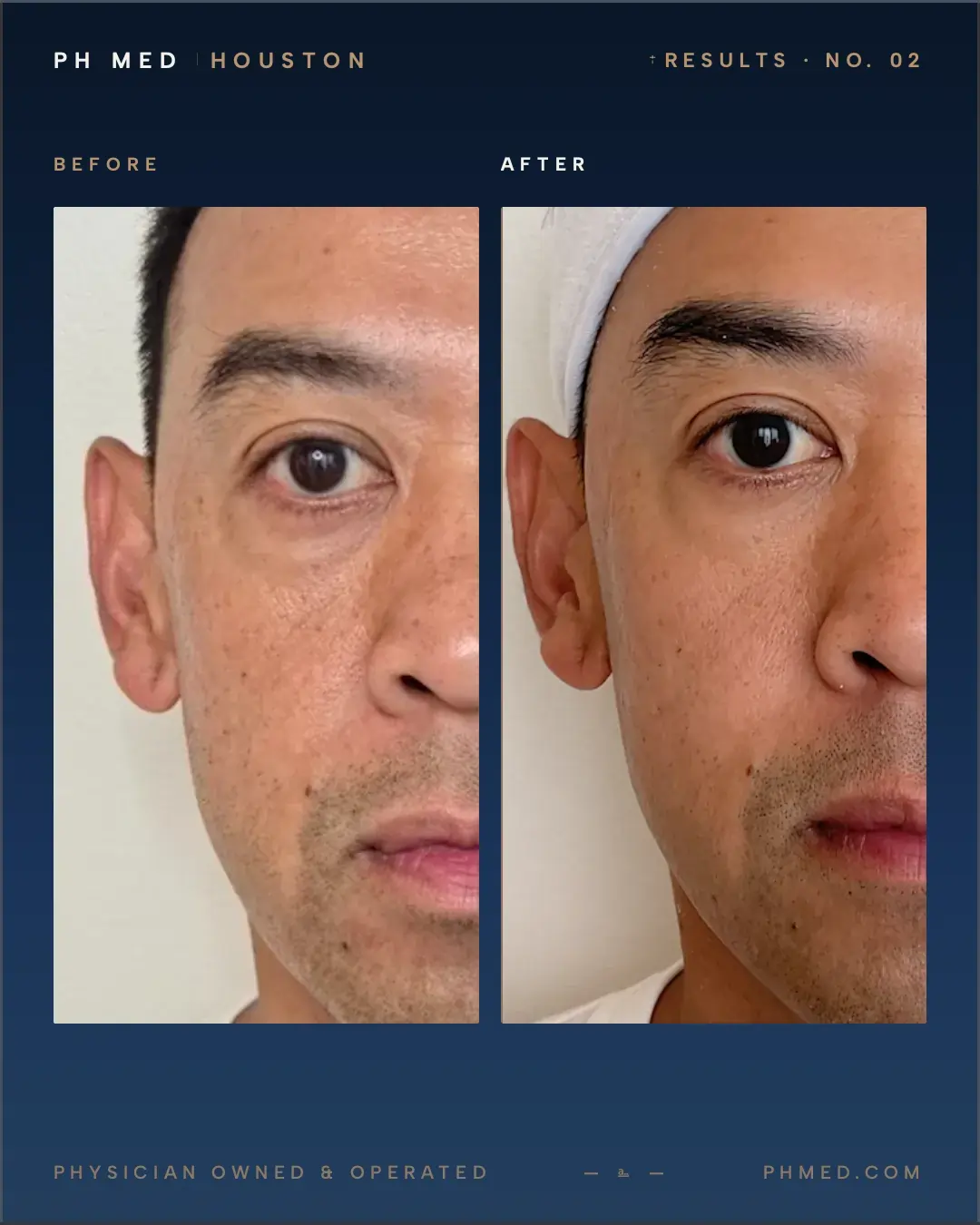 PH Med PRP under eye treatment before and after - periorbital improvement and volume restoration