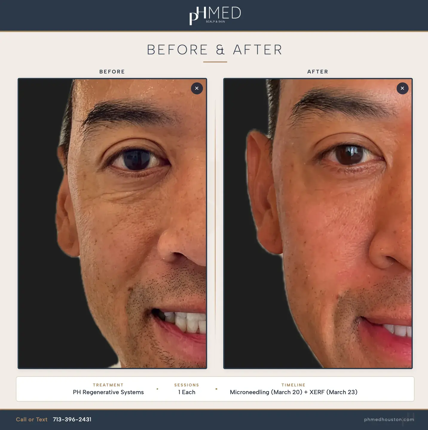 Before and after PH Regenerative Systems microneedling plus XERF stacking results