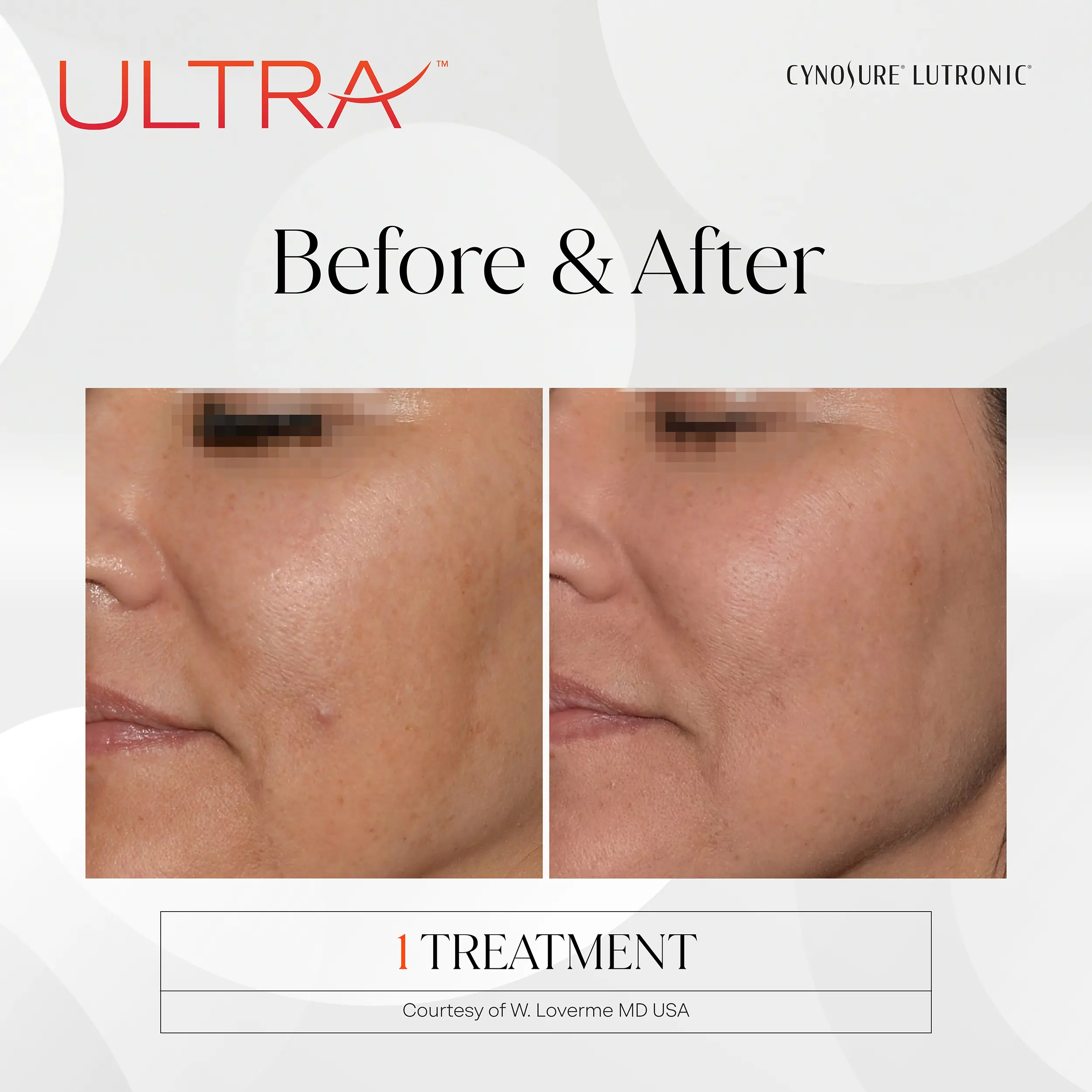 LaseMD Ultra before and after results