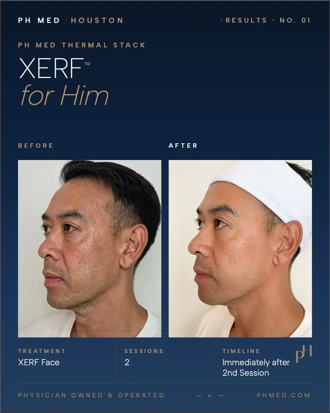 PH Med XERF skin tightening before and after - jawline definition improvement side profile