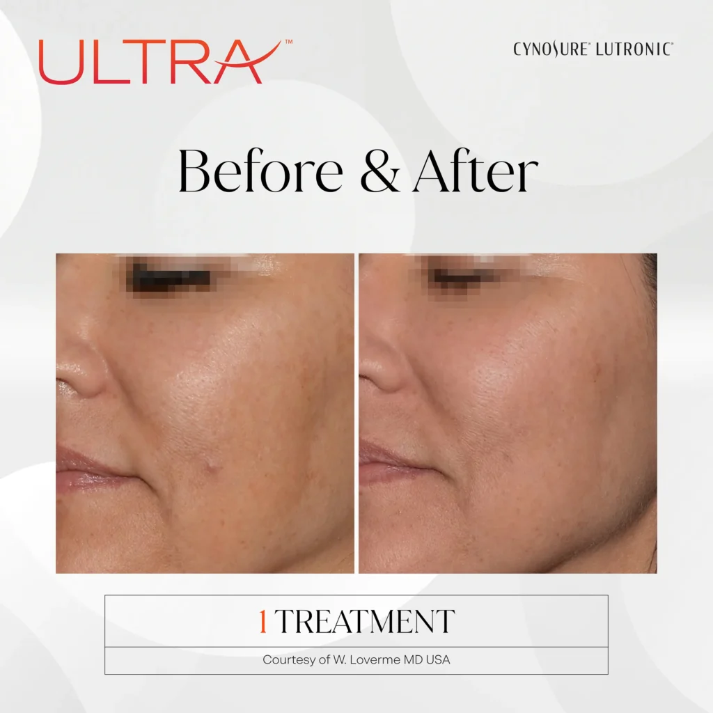 LaseMD Ultra skin treatment promotional image at PH Med Houston