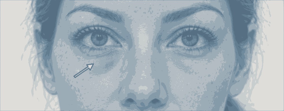 Illustration of blue-gray under-eye discoloration after filler