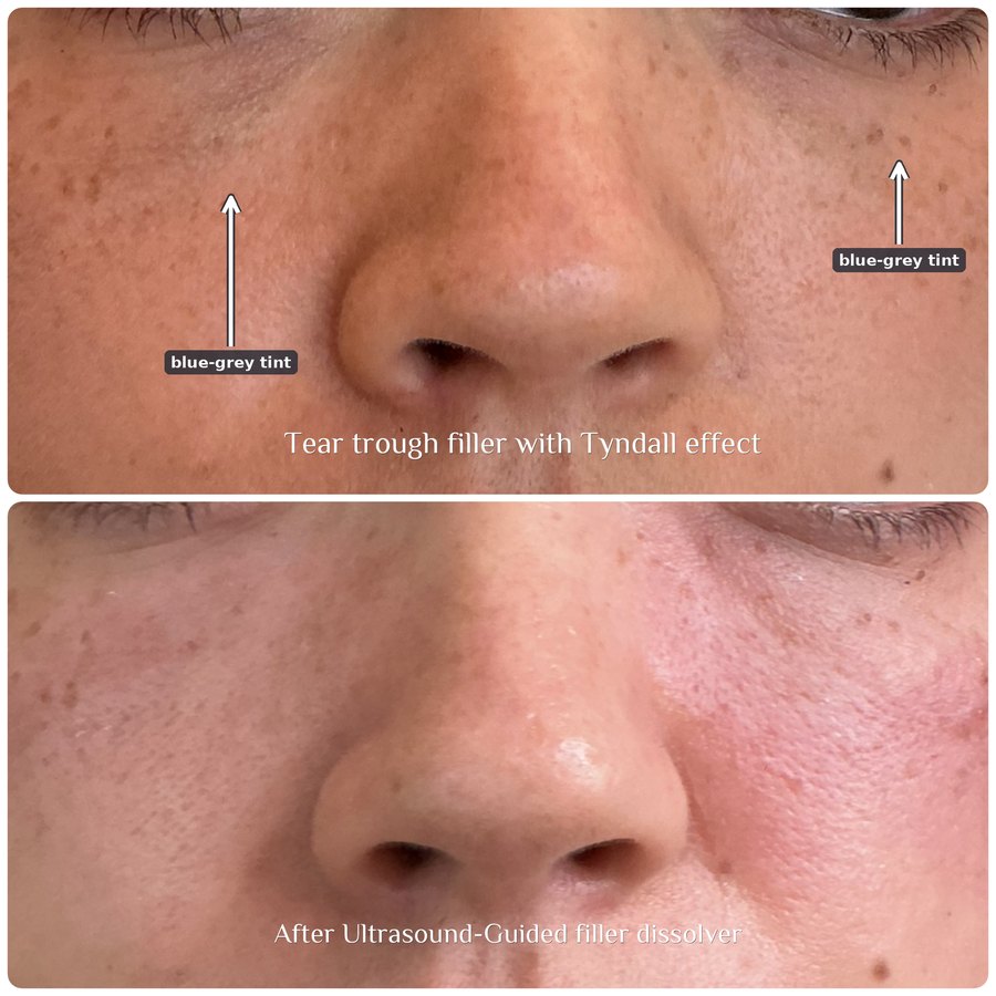 Above: tear-trough filler showing blue-grey discoloration beneath both lower lids, marked with arrows. Below: the same area after ultrasound-guided filler dissolving.