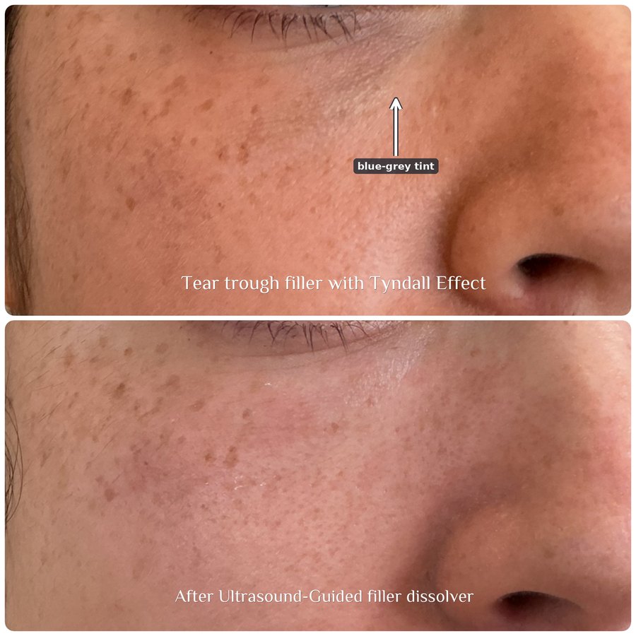 Above: tear-trough filler showing a blue-grey band beneath the lower lid, marked with an arrow. Below: the same area after ultrasound-guided filler dissolving.