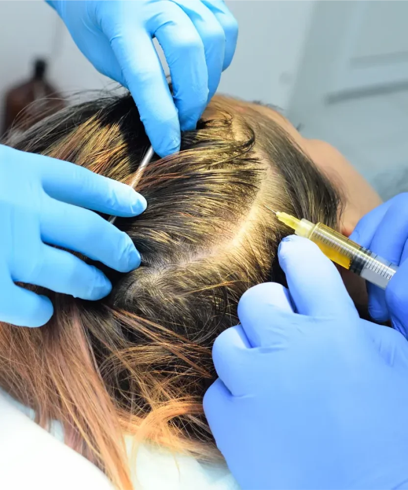 PRP Scalp Treatment in Houston TX