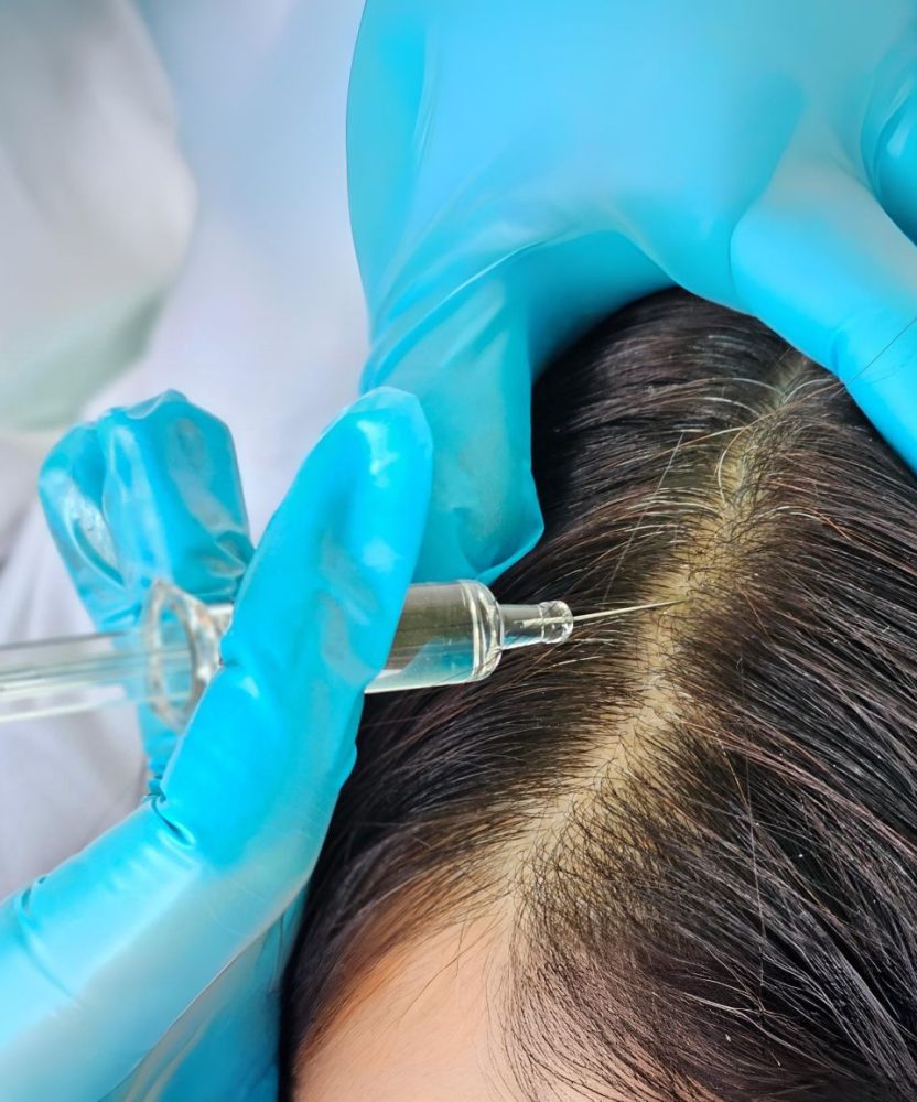 PRP Scalp Treatment in Houston TX